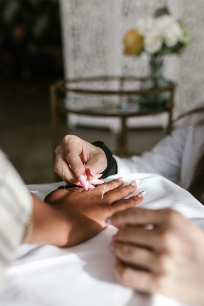 A focused shot of a hand receiving acupuncture therapy, highlighting traditional healing methods.